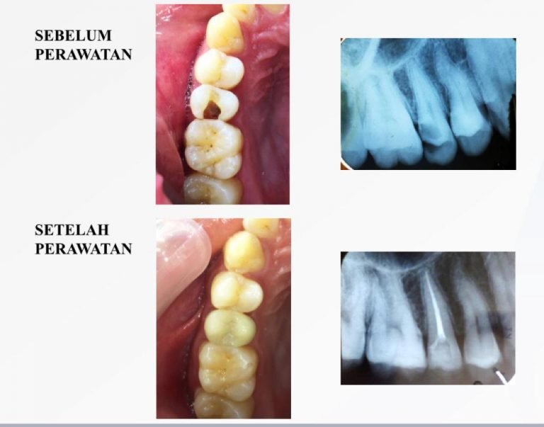 Pengawetan Gigi – Perawatan Saluran Akar Gigi (Endodontik) – IM Dental ...